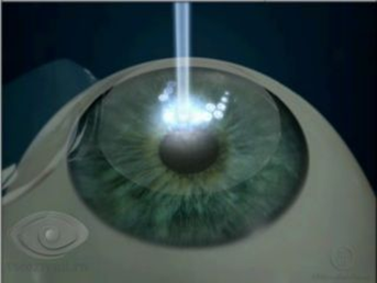 Лечение глаз лазером казань thumbnail